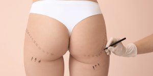 Non-Surgical Facelifts in Alexandria VA